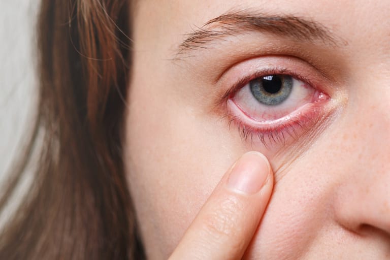 Effective Home Remedies for Eye Itching Relief